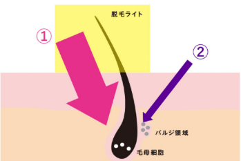 他サロンにはないE‘pearlsだけの脱毛